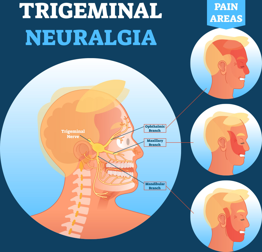 trigeminal neuralgia treatment in Albany, NY